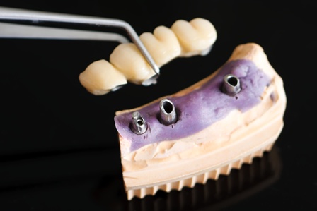 A dentist / dental technician placing the fixed partial denture ( the dental bridge) on the implants.
