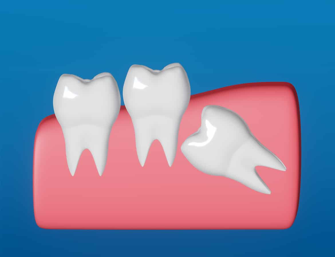 digital graphic of teeth, with wisdom tooth growing in at an angle