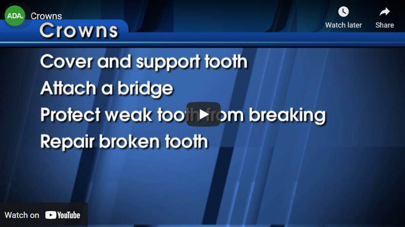 Image of Crowns Click to See Video