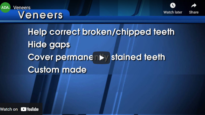 Image of Veneers Click to See Video