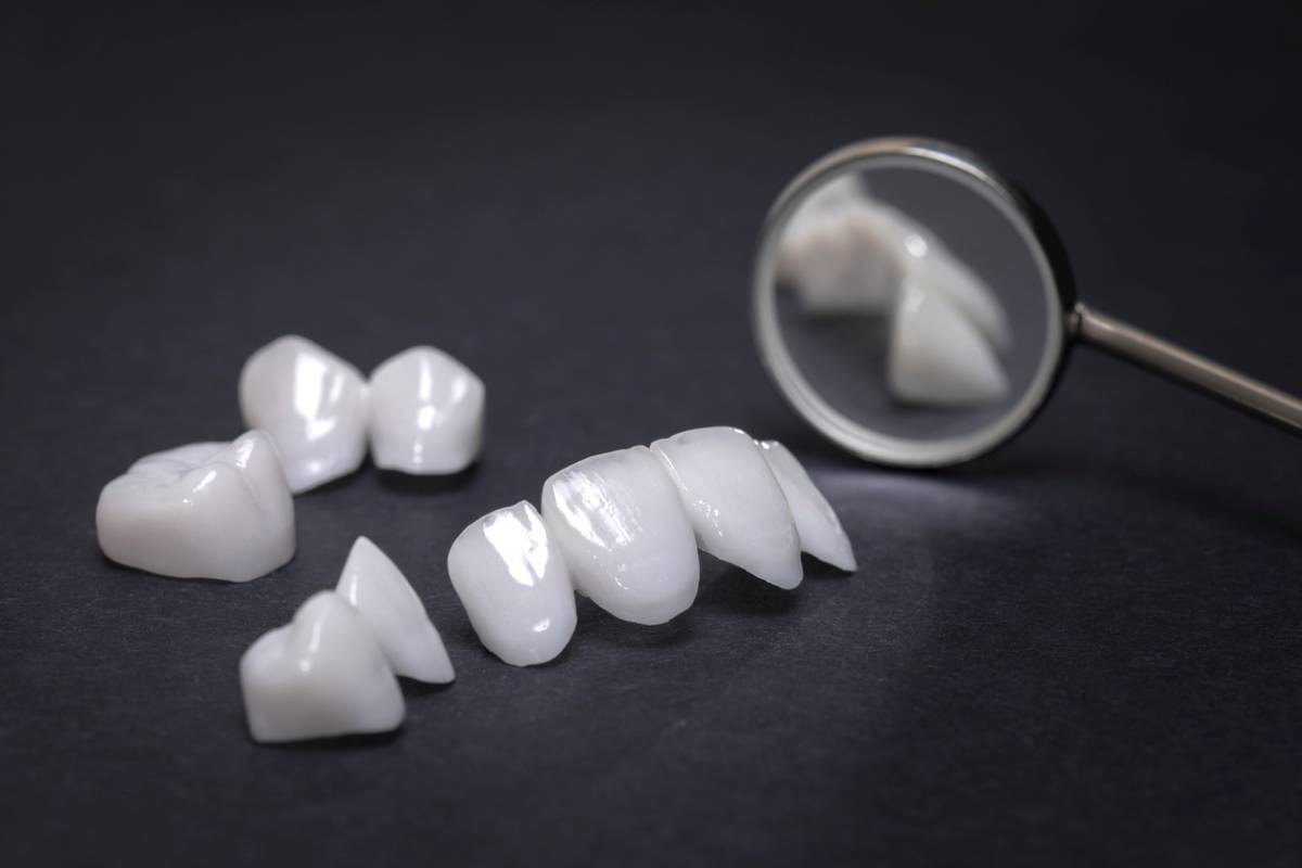 concept of dental bridge keep falling out